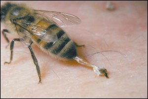 bee-sting-1717_2